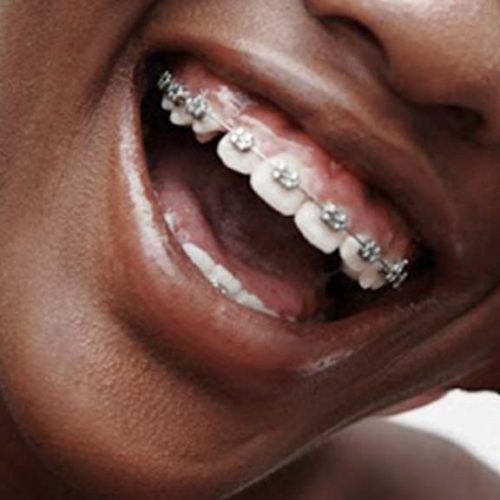 ARE BRACES FOR FASHION?