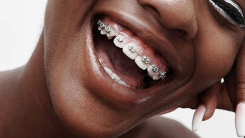 ARE BRACES FOR FASHION?